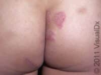 Psoriasis