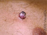 Lobular Capillary Hemangioma (Pyogenic Granuloma) – Adult