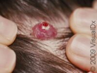Pyogenic Granuloma