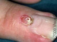 Pyogenic Granuloma