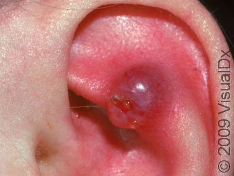 This image displays a lobular capillary hemangioma.