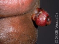 Pyogenic Granuloma