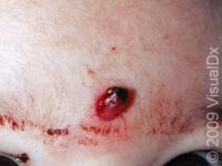 Pyogenic Granuloma