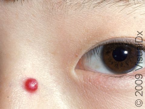 A lobular capillary hemangioma is painless but may bleed easily with minor trauma.