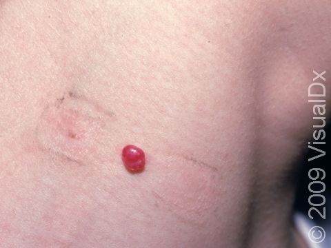 This lobular capillary hemangioma on the neck repeatedly bleeds from clothing friction.