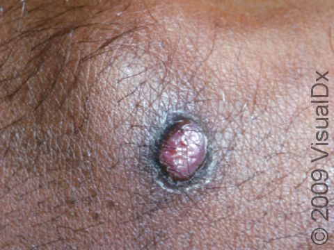 A lobular capillary hemangioma often has a small 