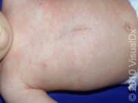 Roseola (Sixth Disease) – Child