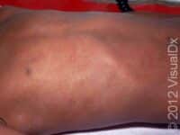 Measles (Rubeola)