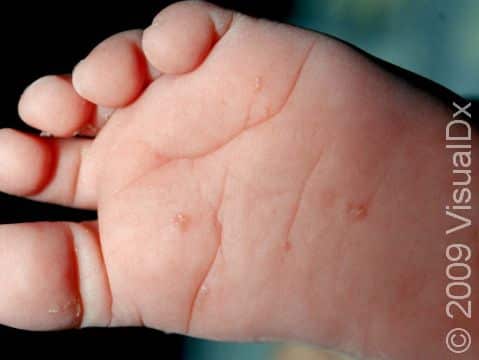 This image displays a fine, small, scaly track in the skin, called a burrow, caused by a scabies infection on the bottom of the feet.