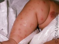 Scabies (Pediatric)