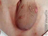 Scabies (Pediatric)