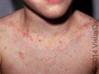Scabies (Pediatric)