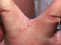 Scabies (Pediatric) – Child