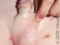 Scabies (Pediatric)