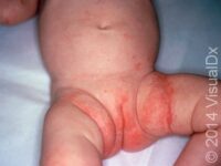 Scabies (Pediatric)