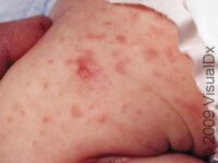 Scabies (Pediatric)