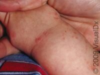 Scabies (Pediatric)