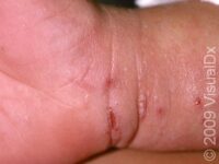 Scabies