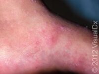 Scabies