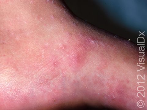 While scabies is usually seen as irregular red, scaling, scratched patches anywhere on the body, there are usually some spots noted on the hands or feet.