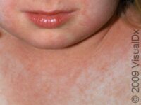 Scarlet Fever