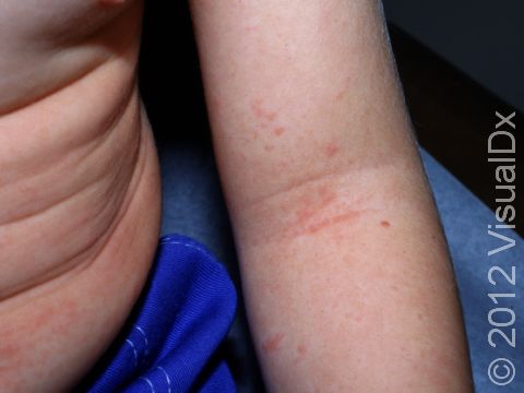 In scarlet fever, the body folds, such as the elbow creases, often have a rash that appears like red lines.