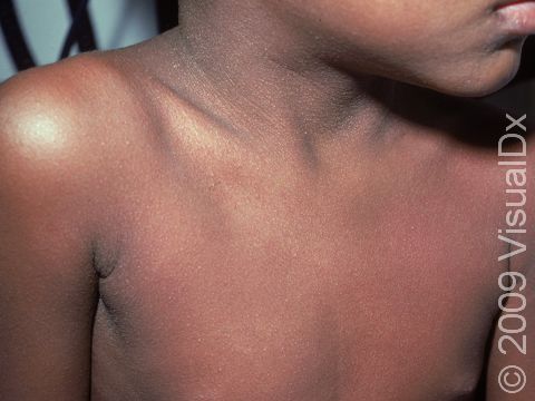 This image displays the faint pink sandpaper-like rash of scarlet fever on the neck and trunk.