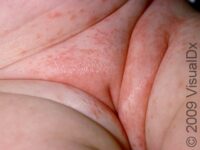 Seborrheic Dermatitis (Pediatric)