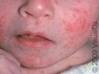 Seborrheic Dermatitis (Pediatric)