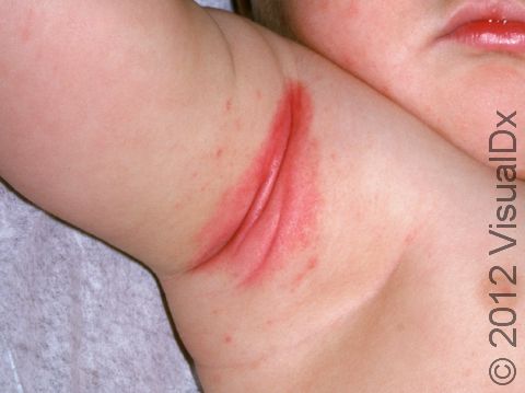 Seborrheic dermatitis often involves body folds, such as the armpits, in infants.