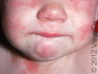 Seborrheic Dermatitis (Pediatric)