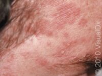 Seborrheic Dermatitis