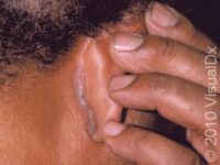 Seborrheic Dermatitis