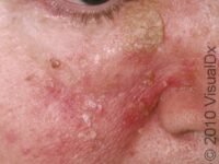 Seborrheic Dermatitis