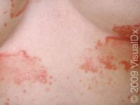 Seborrheic Dermatitis