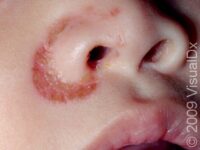 Seborrheic Dermatitis