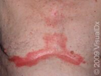 Seborrheic Dermatitis