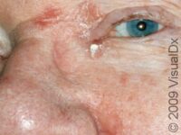 Seborrheic Dermatitis