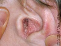 Seborrheic Dermatitis