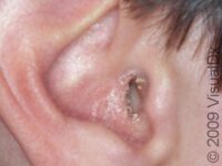 Seborrheic Dermatitis