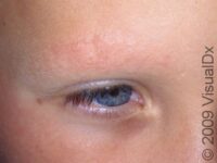 Seborrheic Dermatitis