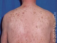 Seborrheic Keratosis – Adult