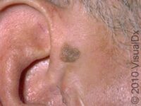 Seborrheic Keratosis