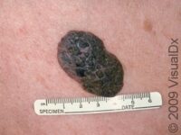 Seborrheic Keratosis
