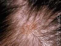 Seborrheic Keratosis