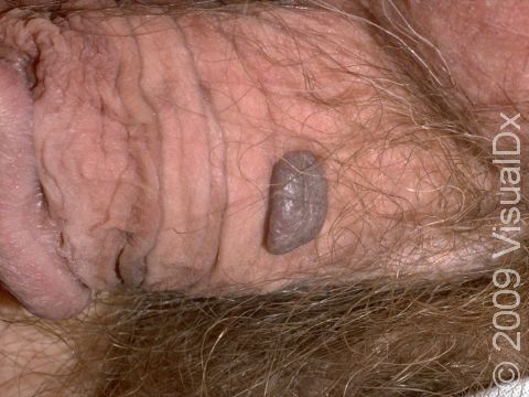 This image displays the waxy and stuck-on appearing, elevated lesion typical of a seborrheic keratosis.