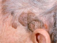 Seborrheic Keratosis