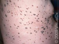 Seborrheic Keratosis