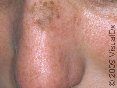 The multiple small, light brown freckles seen here reflect sun damage, but the darker, larger spot on the upper nose bridge is a rough, scaling seborrheic keratosis.