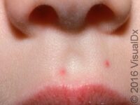 Spider Angioma